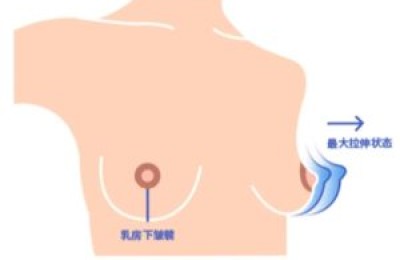 担心脂肪丰胸不够大？假体隆胸不够真？到底怎么选?杏林隆胸